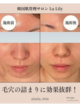 ラ リリー ステラ(La Lily stella)/毛穴洗浄で開いた毛穴とおさらば