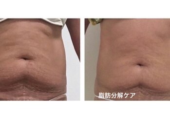 Hb 与野/部分を集中施術-脂肪分解ケア