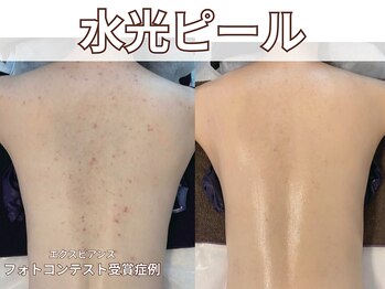 ポレ サロ(pore salo)/【水光ピール｜エクスビアンス】