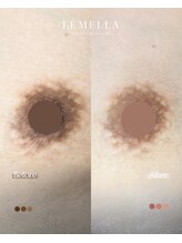 エルビービュティーサロン(LB BEAUTY SALON)/【ルメラ乳輪】実績数関西1★