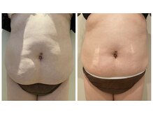 エイシスグロウ(asis glow.)/効果写真