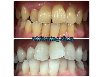 ホワイトニングショップ 天王寺店/40分照射×10回 20代女性