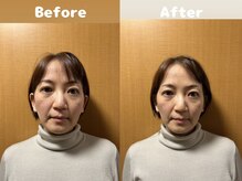 くにたちNyan鍼灸整体院/【小顔矯正】Before After 8