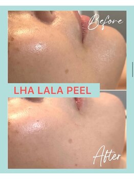 グラント(grant)/【ララピール】ビフォーアフター