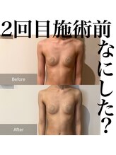 サロンツキ(salon tuki)/バストケア症例