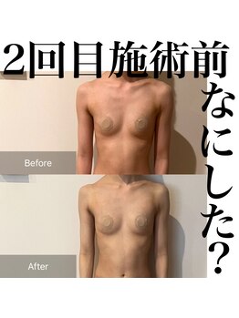 サロンツキ(salon tuki)/バストケア症例