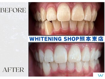 ホワイトニングショップ熊本東店/ホワイトニングショップ熊本東店