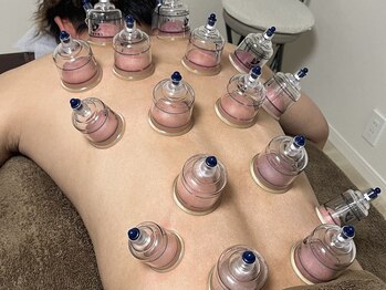 上楽スポーツ鍼灸院/カッピング（吸い玉）