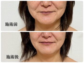 キーオブフェイス(Key of Face)/お悩み【顔全体小さくしたい】