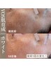 【シミ/しわ/たるみ/美白/エイジング】インディバ＋VOS肌育成 30,000円→