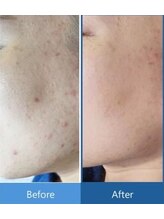 リズ ボーテ/ダクトピール