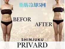 プリバード 新宿店/脂肪冷却５回