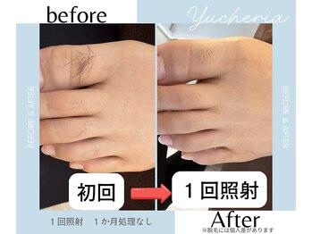 ユシェリア(Yucheria)/足指甲脱毛