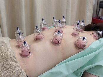 マザーズビューティ鍼灸院整体院 駒沢/☆カッピング☆