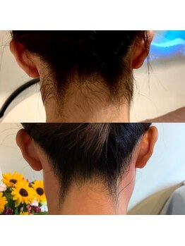 アンジェ 銀座店(Ange)/うなじのW脱毛(ダブル脱毛)