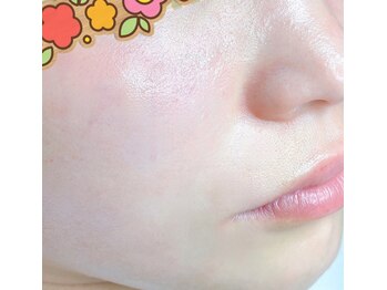 プリエ(Prier)の写真/☆★夏の美白キャンペーン★☆半額以下で超お得!!!→【ハーブピーリング×ハイドロ毛穴洗浄¥22000→¥9800】