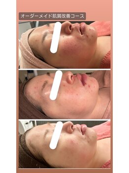 プレジール(Plaisir)/オーダーメイド肌質改善コース