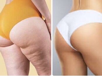 ヨサパーク ミモザ 三軒茶屋店(YOSA PARK Mimosa)/硬い脂肪＝冷えたセル脂肪削減！