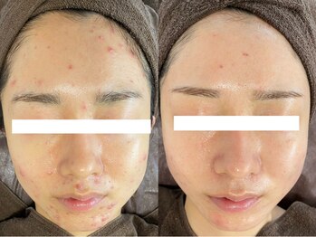 ビスキン(BeSkin)の写真/【肌荒れ/シミ改善/ニキビケアの決定版】高濃度ビタミンCピーリングで肌質改善、くすみケア＆美白にも◎