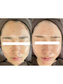 美白ケアをしたい