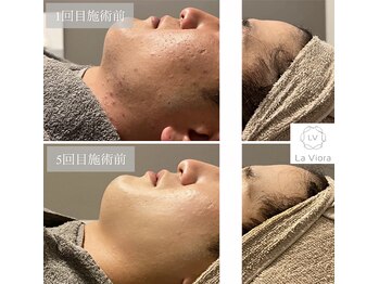 ラヴィオーラ 都島京橋店(La Viora)/ダイヤモンドハーブピーリング