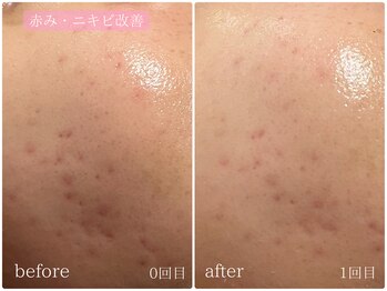 テン(10ten)/赤み・ニキビ改善