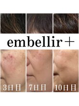 アンベリールプラス(embellir+)/光フォトで気分が上がる