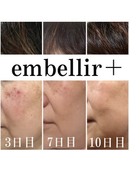 アンベリールプラス(embellir+)/光フォトで気分が上がる