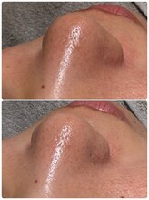 ウルソワン 都島店(/ulu soin)/毛穴改善1回