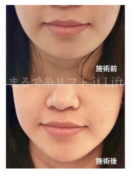 ウルリア(URURIA)/リフトアップ ビフォーアフター