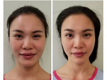 アゴラ/【小顔】【中国での実績もあり】