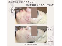 ミリ(MiLi)/ハーブピーリング　ニキビケア