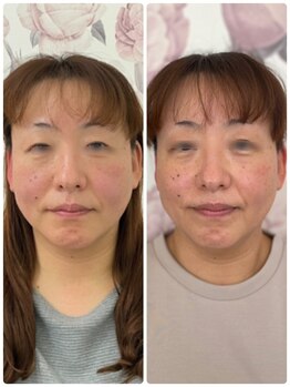 リローゼ(Re.ROSE)/ほうれい線も消えて肌が柔らかく