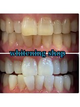 ホワイトニングショップ 鳥取店/ホワイトニングビフォーアフター