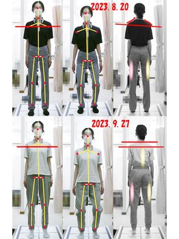 姫路なごみ整体院 なごみ鍼灸院/改善例（肩甲骨痛み股関節の痛）