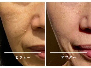 クク 赤坂 天神(99 KUKU)/60代/ほうれい線消失