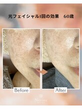 ネリネ(Nerine)/光フェイシャル1回の効果