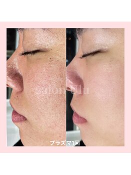 ウル(Ulu)/プラズマフェイシャルとは？