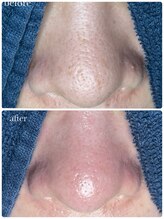 サロン ド ラム/【毛穴改善コース】2回目の効果