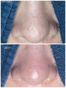 サロン ド ラム/【毛穴改善コース】2回目の効果