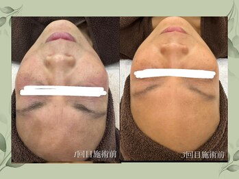 サロン ド コウ(Salon de KOU)/gloss肌トリートメント　