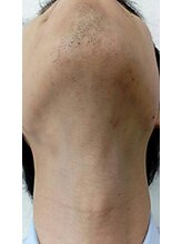 ヘアーデザインオアシス(Oasis)/【ヒゲ脱毛】