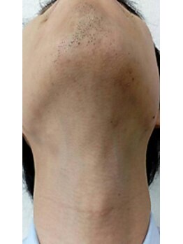 ヘアーデザインオアシス(Oasis)/【ヒゲ脱毛】