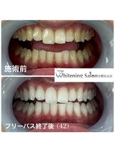 ホワイトニングサロン 京都烏丸店/ホワイトニング施術例