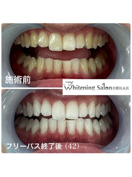 ホワイトニングサロン 京都烏丸店/ホワイトニング施術例