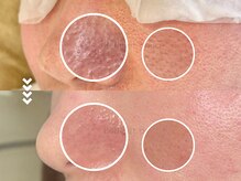 ベルエドゥース(Belle et Douce)の雰囲気（毛穴の凹凸もここまで変化します！）