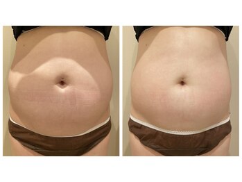 エイシスグロウ(asis glow.)/効果写真