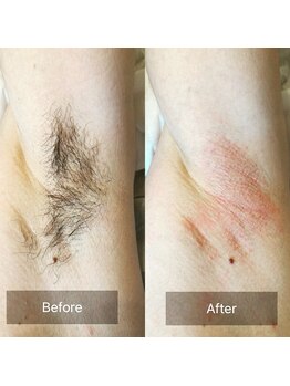 ベルヴィー(Belle vie)/脇脱毛