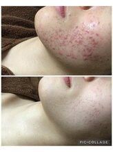 ビークレアーズ ビビ(B-crears. ViVi)/顔ハーブピーリング