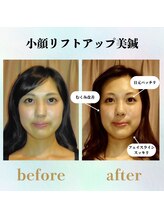 ラ コンシェル 代々木上原店/リフトアップ美鍼、お客様の結果